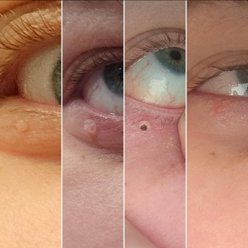 Novira FreeDerm™